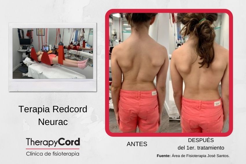 TherapyCord Redcord Neurac caso paciente